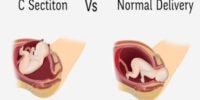 CSection vs Normal