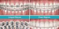 Dental braces types