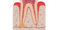 abscessed tooth dental