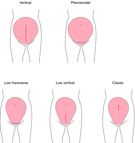 c sections types