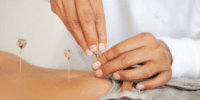 fertility acupuncture