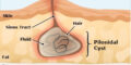 pilonidal sinus