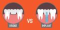 dental Implants Vs bridges
