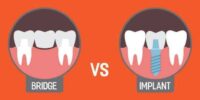 dental Implants Vs bridges