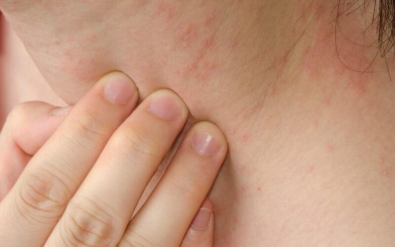 Diary Rash Dairy allergy – myths and facts