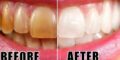 DIY Teeth Whitening