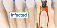 root canal explained