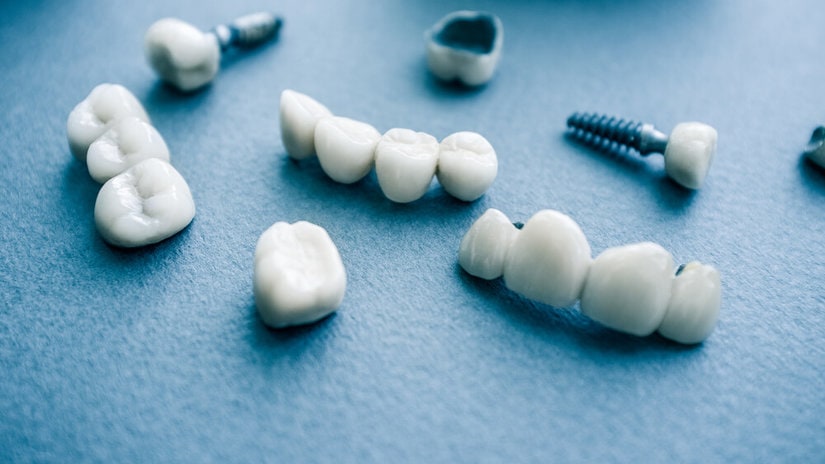 Affordable Dental Implants - How To Find Low Cost Options