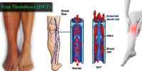 Blood Clots And Deep Vein Thrombosis: Prevention And Treatment