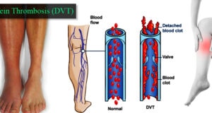 Blood Clots And Deep Vein Thrombosis: Prevention And Treatment