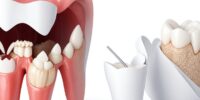 Dental Caries