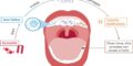 Dental Caries - Causes, Symptoms, And Treatment