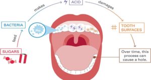 Dental Caries - Causes, Symptoms, And Treatment