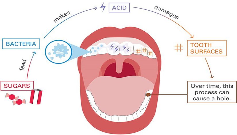 Dental Caries - Causes, Symptoms, And Treatment