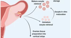 Fertility Preservation Tourism: Preserving Your Future Family