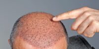 Hair Transplant Tourism: Restoring Confidence With Hair Restoration