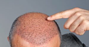 Hair Transplant Tourism: Restoring Confidence With Hair Restoration