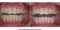 How Much Does Teeth Whitening Cost?