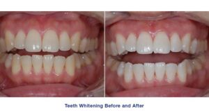 How Much Does Teeth Whitening Cost?