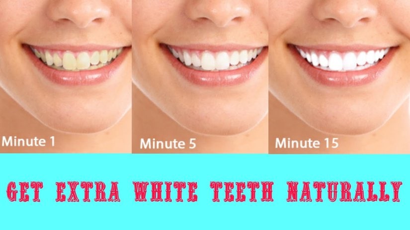 Natural Teeth Whitening - Tricks For A Whiter Smile