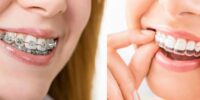 Orthodontic Tourism: Straightening Smiles Around The World