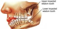 Should I Get My Wisdom Taken Out? Wisdom Teeth Removal Cost And Benefits