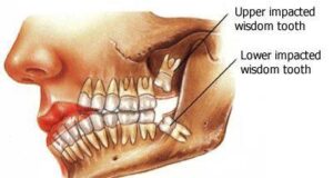 Should I Get My Wisdom Taken Out? Wisdom Teeth Removal Cost And Benefits