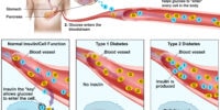 The Connection Between Blood Sugar And Diabetes