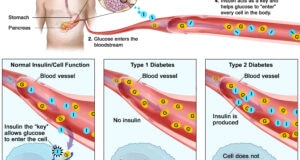 The Connection Between Blood Sugar And Diabetes