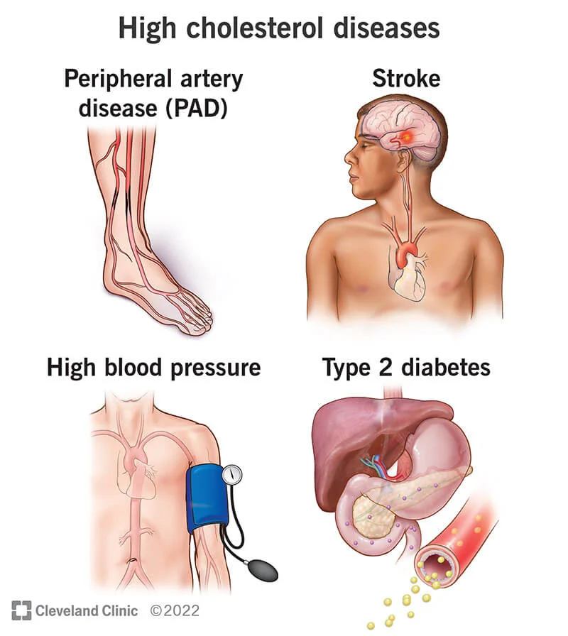 The Impact Of High Cholesterol On Blood Health