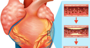 What Is The Cardiovascular System? Hypertension And Heart Disease