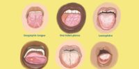 White Tongue - Causes, Conditions, And Treatment
