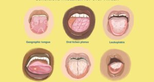 White Tongue - Causes, Conditions, And Treatment