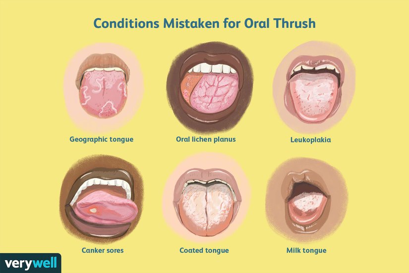 White Tongue - Causes, Conditions, And Treatment