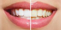Yellow Teeth - Causes, Home Remedies, And Treatment Options