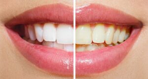 Yellow Teeth - Causes, Home Remedies, And Treatment Options