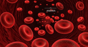 Anemia