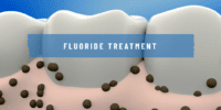 fluoride treatment