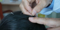 Scalp Acupuncture Vs. Body Acupuncture