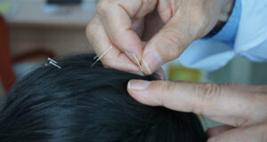 Scalp Acupuncture Vs. Body Acupuncture