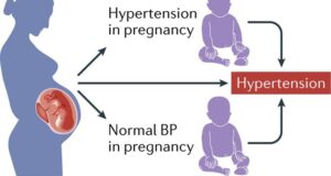 Manage Hypertension During Pregnancy