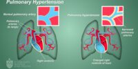 Hypertension Is Linked To Rheumatic Heart Disease