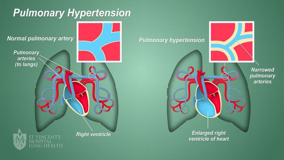 Hypertension Is Linked To Rheumatic Heart Disease