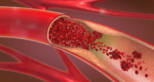 Hypertension Is Related To Peripheral Artery Disease