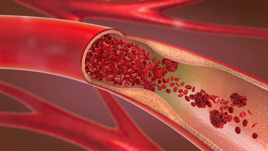 Hypertension Is Related To Peripheral Artery Disease