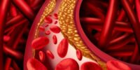 Hypertension Is Linked To Atherosclerosis