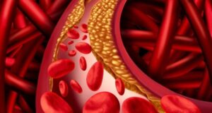 Hypertension Is Linked To Atherosclerosis