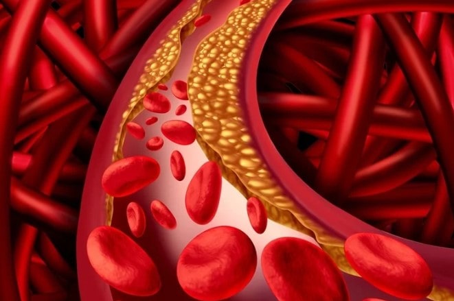Hypertension Is Linked To Atherosclerosis