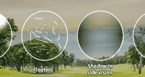 Retinal Detachment